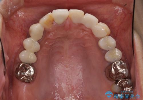 以前治療した歯が続々とむし歯に　全顎むし歯治療の治療前