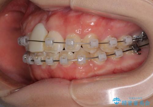 怪我をして不格好な前歯 矯正治療とインプラント補綴治療の治療中