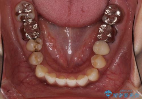 以前治療した歯が続々とむし歯に 全顎むし歯治療の治療前