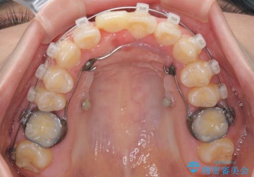 怪我をして不格好な前歯 矯正治療とインプラント補綴治療の治療中