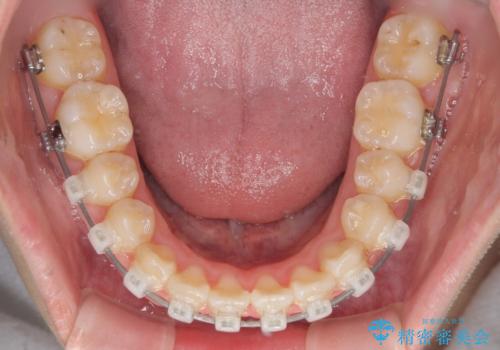 怪我をして不格好な前歯 矯正治療とインプラント補綴治療の治療中