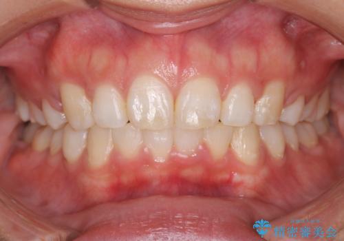 出っ歯の矯正 ワイヤーによる抜歯矯正での改善の治療後