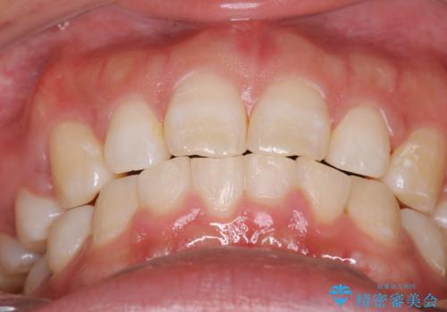 出っ歯の矯正　ワイヤーによる抜歯矯正での改善の治療後