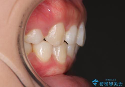 出っ歯の矯正 ワイヤーによる抜歯矯正での改善の治療後