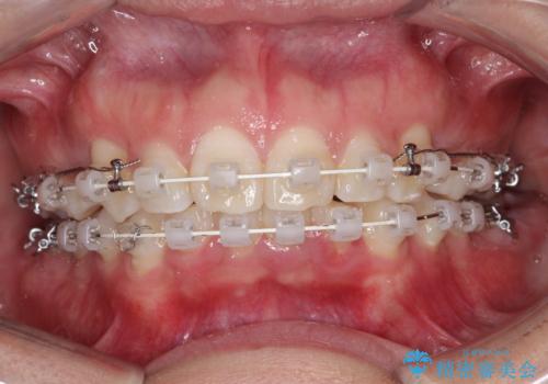 出っ歯の矯正 ワイヤーによる抜歯矯正での改善の治療中