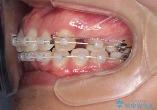 出っ歯の矯正 ワイヤーによる抜歯矯正での改善の治療中