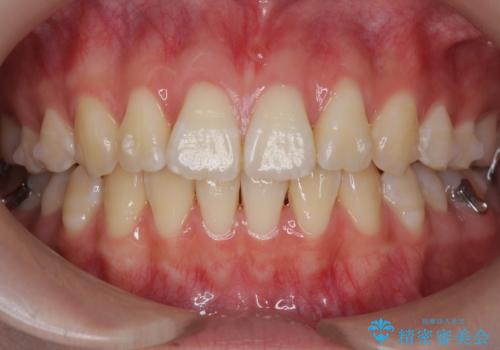 出っ歯 軽度のがたつき インビザラインでの治療中
