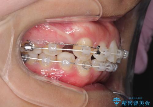出っ歯の矯正　ワイヤーによる抜歯矯正での改善の治療中