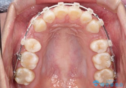 出っ歯の矯正　ワイヤーによる抜歯矯正での改善の治療中