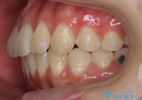 出っ歯 軽度のがたつき インビザラインでの治療中