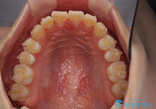 出っ歯 軽度のがたつき インビザラインでの治療中