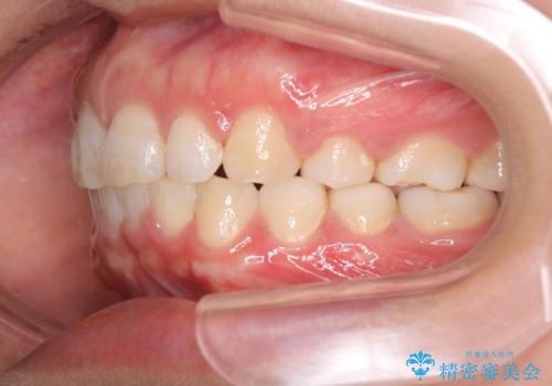 出っ歯の矯正 ワイヤーによる抜歯矯正での改善の治療後