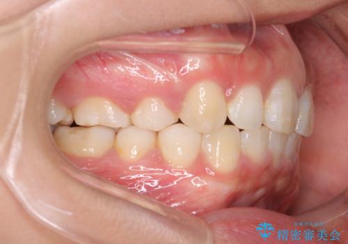 出っ歯の矯正　ワイヤーによる抜歯矯正での改善の症例 治療後