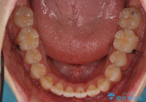 出っ歯 軽度のがたつき インビザラインでの治療中