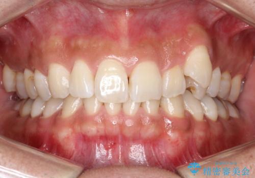 八重歯をインビザラインで矯正　大人の目立たない矯正の症例 治療前