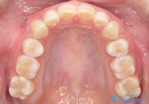 出っ歯の矯正　ワイヤーによる抜歯矯正での改善の治療後