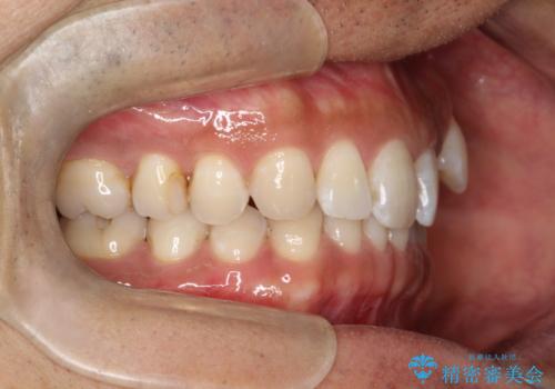 八重歯をインビザラインで矯正 大人の目立たない矯正の治療前