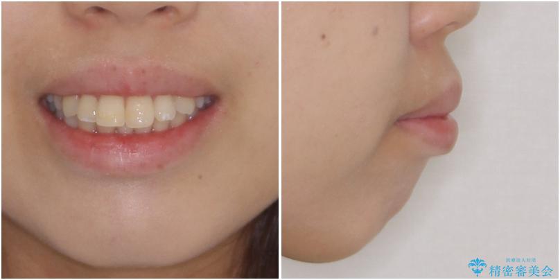 突出した口元が気になる ハーフリンガル装置による抜歯矯正の治療前(顔貌)