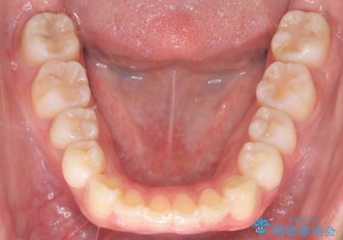 出っ歯の矯正 ワイヤーによる抜歯矯正での改善の治療後