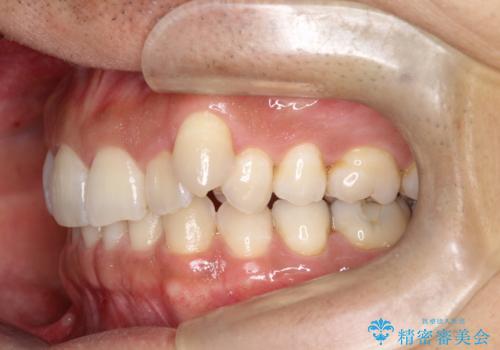 八重歯をインビザラインで矯正 大人の目立たない矯正の治療前