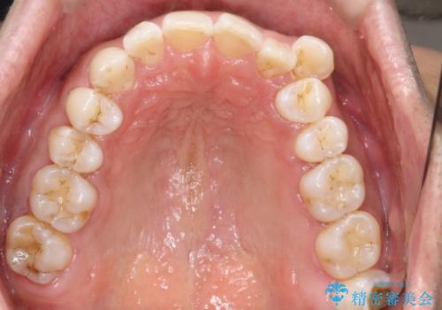 八重歯をインビザラインで矯正 大人の目立たない矯正の治療前