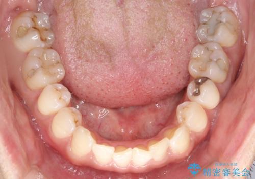 八重歯をインビザラインで矯正 大人の目立たない矯正の治療前