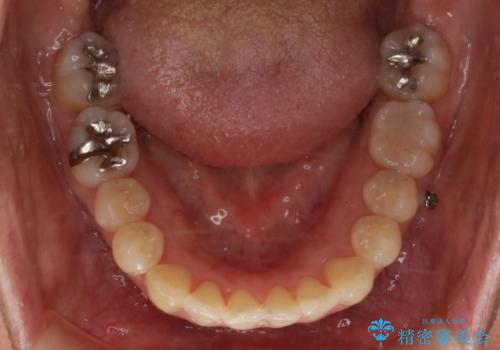 銀歯を白くしたい:矯正後に綺麗なセラミックへの治療前
