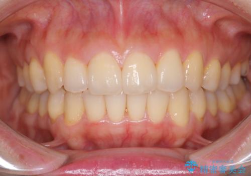 前歯が前後反対にかんでいる　インビザラインによる目立たない矯正の症例 治療後