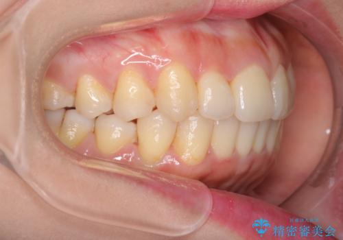 前歯が前後反対にかんでいる　インビザラインによる目立たない矯正の治療後