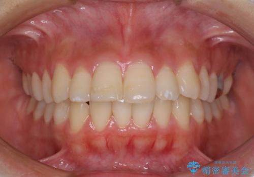 突出した口元が気になる ハーフリンガル装置による抜歯矯正の症例 治療前