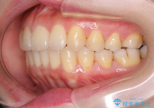 前歯が前後反対にかんでいる インビザラインによる目立たない矯正の治療後