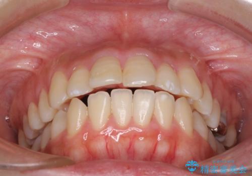 突出した口元が気になる ハーフリンガル装置による抜歯矯正の治療前