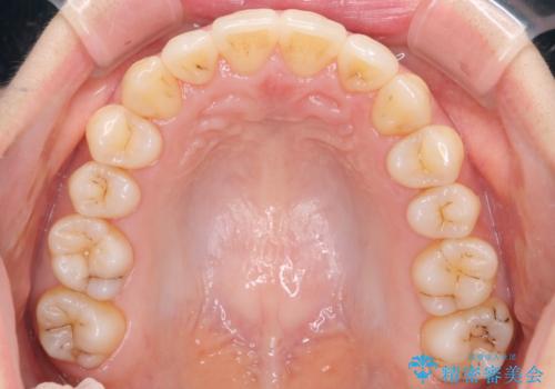 前歯が前後反対にかんでいる　インビザラインによる目立たない矯正の治療後
