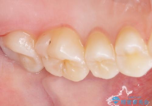 気づかなかった奥歯のう蝕 セラミックインレー 20代女性の治療後