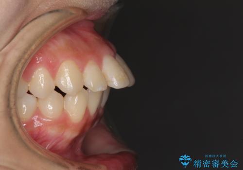 突出した口元が気になる ハーフリンガル装置による抜歯矯正の治療前