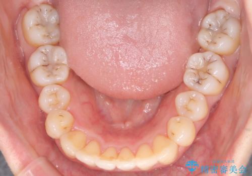 前歯が前後反対にかんでいる インビザラインによる目立たない矯正の治療後