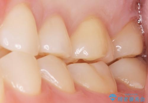 気づかなかった奥歯のう蝕 セラミックインレー 20代女性の治療後