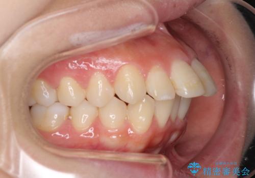 突出した口元が気になる ハーフリンガル装置による抜歯矯正の治療前