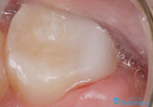 気づかなかった奥歯のう蝕 セラミックインレー 20代女性の治療後