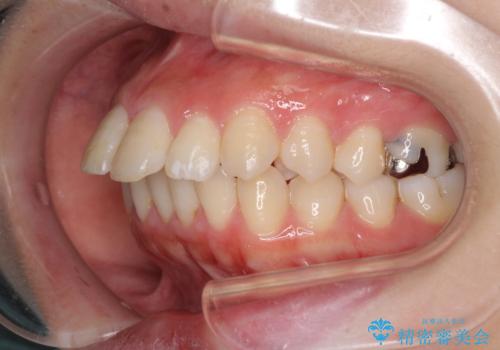 突出した口元が気になる ハーフリンガル装置による抜歯矯正の治療前