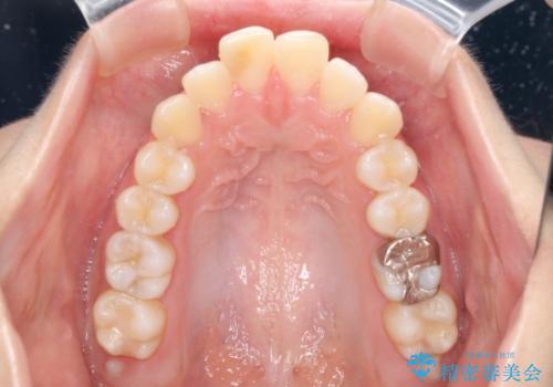 突出した口元が気になる ハーフリンガル装置による抜歯矯正の治療前