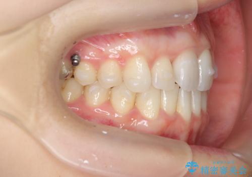 [ インビザライン矯正 ]  マウスピース矯正で治す、前歯のガタつきの治療中