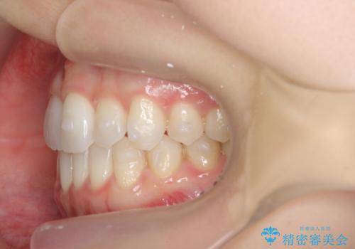[ インビザライン矯正 ]  マウスピース矯正で治す、前歯のガタつきの治療中