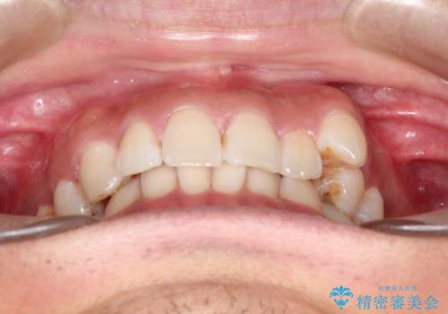 八重歯をインビザラインで矯正　大人の目立たない矯正の治療前