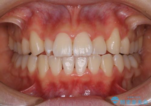 矯正中のPMTC60分コースの治療後