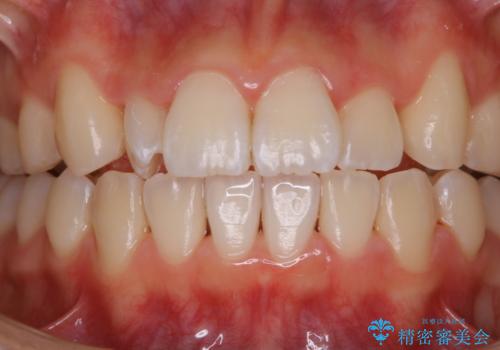 矯正中のPMTC60分コースの症例 治療後