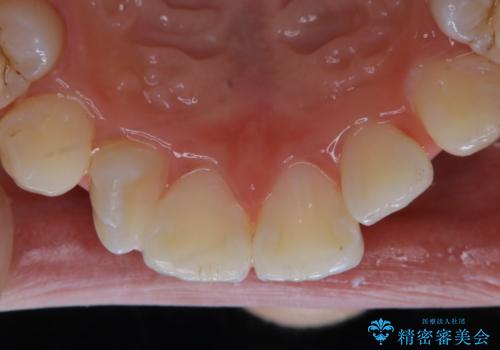 矯正中のPMTC60分コースの治療後
