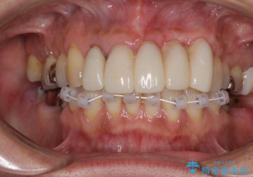 気になる所を一気に治療 総合歯科治療の治療中