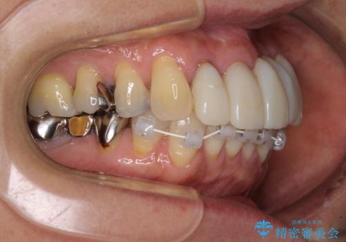 気になる所を一気に治療 総合歯科治療の治療中