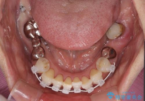 気になる所を一気に治療 総合歯科治療の治療中